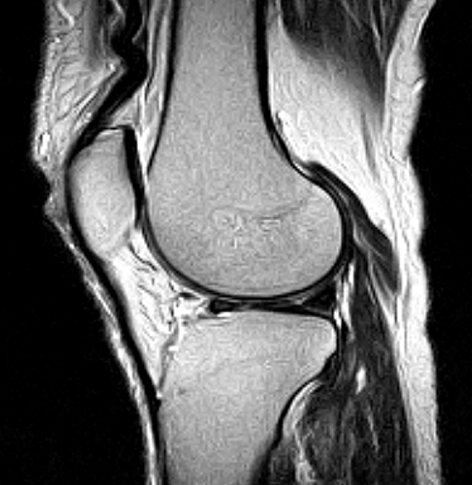 Knee Sagittal MRI scan